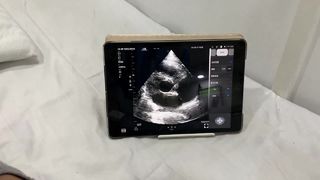Sonda ecografica wireless a doppia testa per cardiaco e POCUS